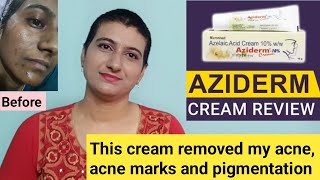 This cream removed my acne acne marks and pigmentation  Aziderm azelaic acid cream review telugu [upl. by Ori]