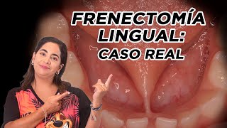 Frenectomía lingual caso real [upl. by Leahpar]