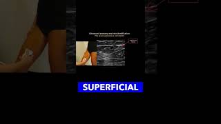 Identifying the Great Saphenous Vein vascularultrasound healthcareexcellence MedicalEducation [upl. by Delfine778]