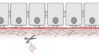 Effects of proteinases with metalloproteinase domains MMPs ADAMs on tumour progression [upl. by Yenruoc425]