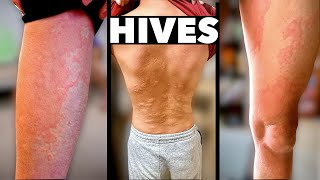 HIVES EVERYWHERE What Caused This Allergic Reaction  Dr Paul [upl. by Ahsietal]