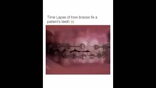 Time Lapse of how braces fix a patients teeth shorts [upl. by Nagad]