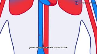 La thrombose veineuse profonde [upl. by Yi]