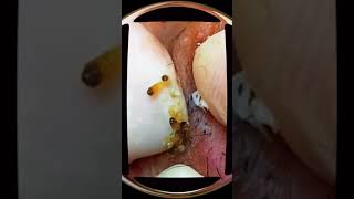 cravos pretos no rosto escreva se no canal para mais vídeos compartilhe acne blackhead [upl. by Eesak]