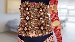 ASMR Treatment Animation Remove Maggot Girl Belly  Pimple Popping ASMR  2D Animation PaponASMR [upl. by Erdah656]