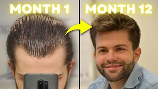 How I Regrew My Hair Using 3 Proven Treatments MonthbyMonth Results [upl. by Mikes]