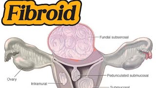 Uterine Fibroid  Mass Uterus  DUB on ultrasound [upl. by Reeves]