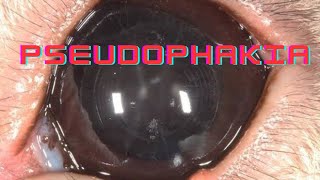 Pseudophakia  Artephakia  Ophthalmology Lecture [upl. by Yahiya]