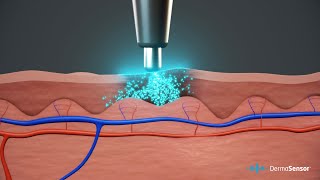 Skin Cancer Detection with DermaSensor [upl. by Enisamoht]