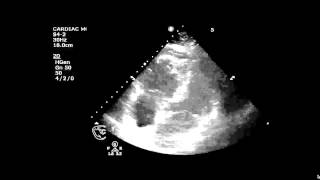 Pulmonary Embolus McConnells Sign [upl. by Buller]