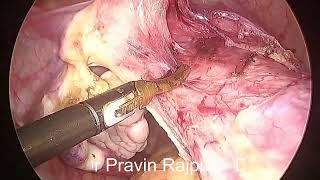 Total laparoscopic hysterectomy TLH [upl. by Ecinehs244]