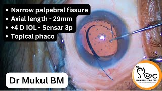 4D IOL  Topical phaco in High Myope [upl. by Gathard]