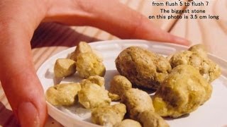 Liver Detoxify Gall Stone Cleanse Removal Of Gallstones Gallstone Attacks [upl. by Iznek]