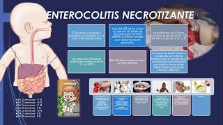 ENTEROCOLITIS NECROTIZANTE CAPITULO 1 [upl. by Cheria128]