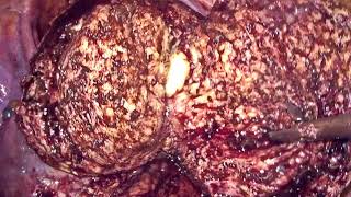 Part 2 Wedge Resection for Adenomyosis [upl. by Annodas]