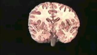 Split Brain SyndromeExplained [upl. by Thin]