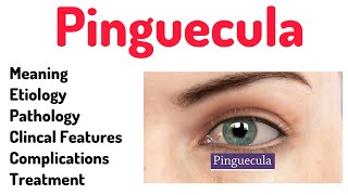 Pinguecula Conjunctival Anomalypinguecula eyes optometrists optometry [upl. by Oiratno]