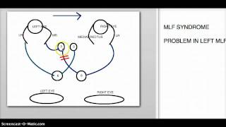 MLF SYNDROME PATHWAY [upl. by Nitsur375]