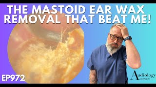 THE MASTOID EAR WAX REMOVAL THAT BEAT ME  EP972 [upl. by Ahcsrop903]