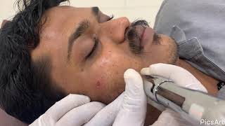 Microneedling Treatment For Chicken Pox Scar Marks On Skin by Dr Vaseem Choudhary [upl. by Yoccm]