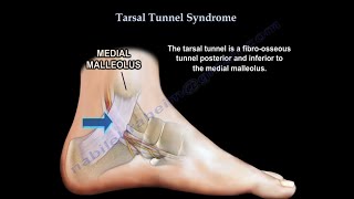 Tarsal Tunnel Syndrome causes and treatment [upl. by Nilde]