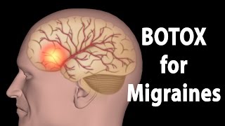 BOTOX for Migraines Animation [upl. by Sadie]