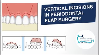 BASIC INCISIONS VERTICAL RELEASING INCISIONS IN PERIODONTAL FLAP SURGERY DR ANKITA KOTECHA [upl. by Sueahccaz252]