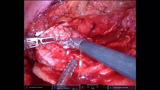 Robotic Nephron Sparing Surgery for Large Endophytic Renal Mass [upl. by Ocirnor]