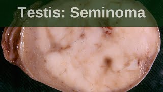 Testicular germ cell tumours  Seminoma  Pathology mini tutorial [upl. by Dickerson]