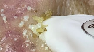 Acne treatment for Spa Linh Mun 2024 49 [upl. by Delmar]