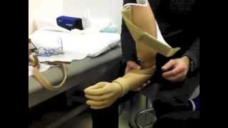 The Process Of Getting A Prosthetic Arm  Pt 2 [upl. by Lamraj]