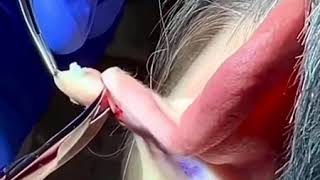 Cyst Removal on Earlobe [upl. by Akoek]