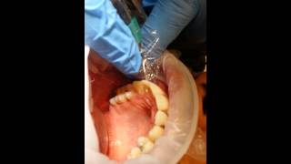 How To Needlefree dental injection by Dr Roslyn Skinner [upl. by Beulah]