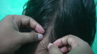 Lice Infested Catching and Popping Sounds  ASMR Lice Picking In My Head [upl. by Nathanael]