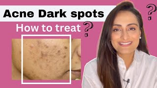 Acne Dark Spots  हिंदी  How to treat  serum cream recommendations  Dermatologist  Dr Aanchal [upl. by Ydnik]