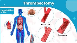 Endovascular thrombectomy  is a invasive surgical procedure treat acute ischemic stroke [upl. by Lamar625]