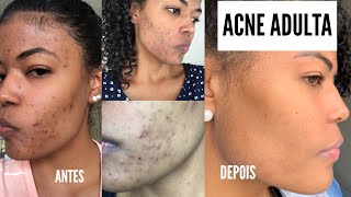 ACNE ADULTA  Minha experiência tratamento produtos e manchas Antes e Depois com fotos [upl. by Mcclary]