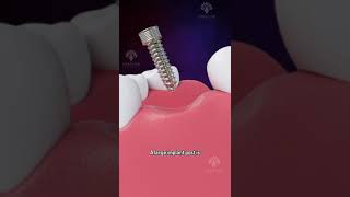 Bone Grafting for Dental Implants shorts facts  creativelearning3d [upl. by Annayhs956]