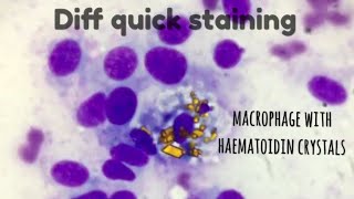 Diff quick staining procedure and interesting case photos [upl. by Prager]