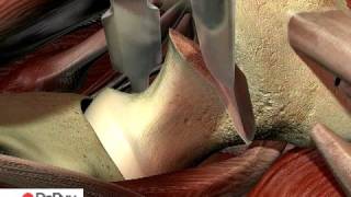 Video 4 Anterior Surgical Approach [upl. by Elman]