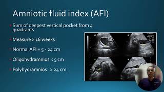 how to measure Amniotic fluid index [upl. by Enilatan522]