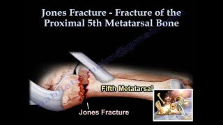 Jones Fracture  Everything You Need To Know  Dr Nabil Ebraheim [upl. by Attikram818]