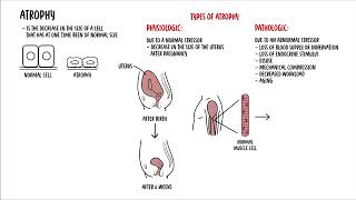 Cellular Adaptation  hyperplasia hypertrophy atrophy and metaplasia  cell injury [upl. by Arenahs]