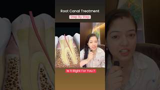 rootcanaltreatment shorts rootcanalspecialist rootcanal dental information doctor [upl. by Lleraj]