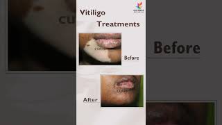 Vitiligo treatment  Cutis Hospital Bangalore  Vitiligo Before and After [upl. by Eirallam]