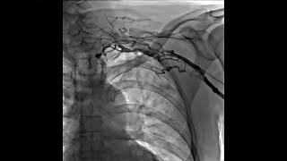 Left Upper Extremity Venogram of Thrombosis of Left Subclavian Vein With Network of Small Veins [upl. by Areek]