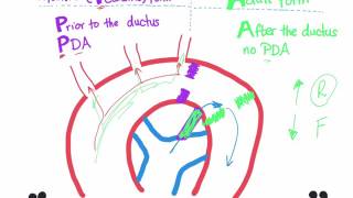 Coarctation of aorta Infantile type vs adult type mnemonic [upl. by Alimat]