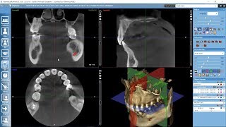 Examining 3D images in Planmeca Romexis [upl. by Auqenahs]