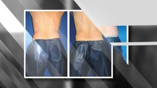 Phoenix Liposuction Results Male Waist [upl. by Noret]