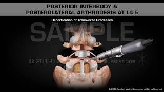 Posterior Interbody amp Posterolateral Arthrodesis at L45  Medical Animation [upl. by Arolf217]